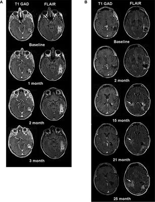Case Report: Prolonged Survival Following EGFRvIII CAR T Cell Treatment for Recurrent Glioblastoma